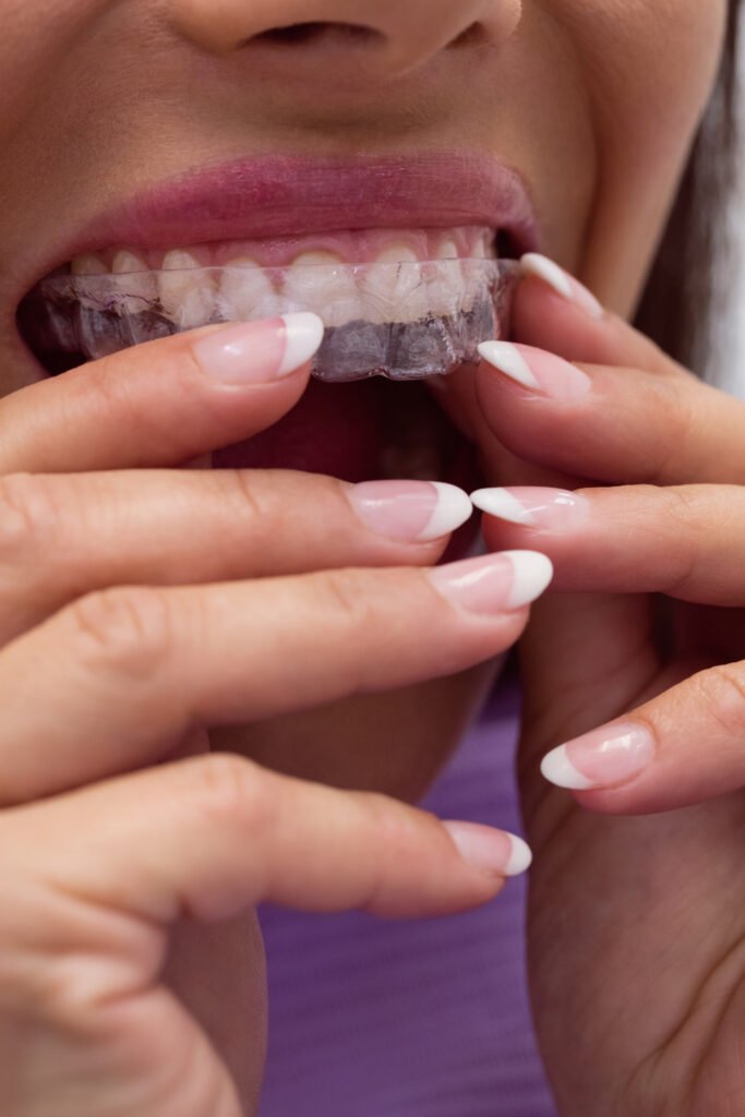 aligners
